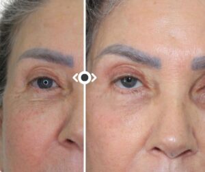 Before and After Morpheus 8