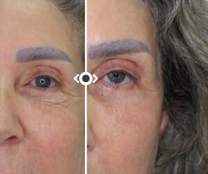 Before and After Morpheus 8