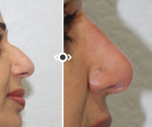 Before and After Liquid Rhinoplasty
