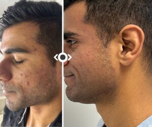 Before and After Acne with Aviclear