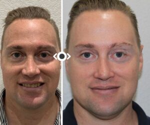 Before and After CO2 Laser