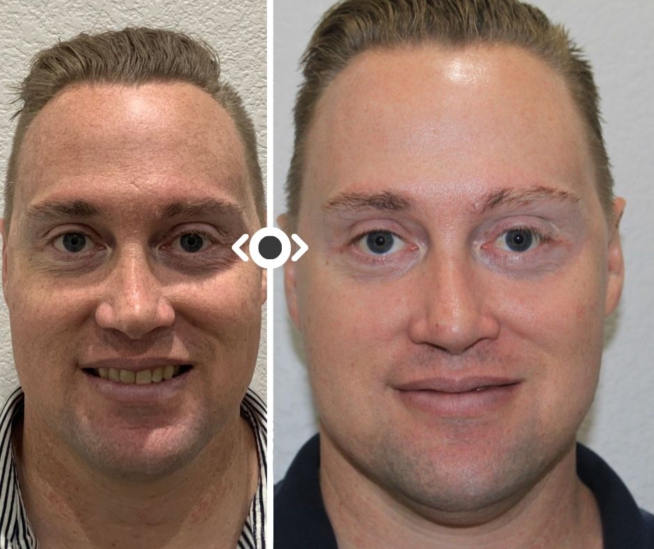 Before and After CO2 Laser