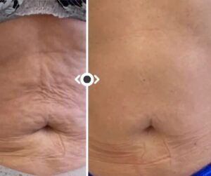 Before and After Endolaser