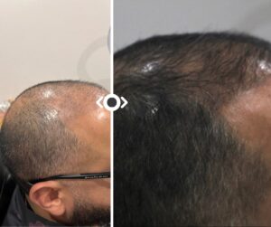 Before and After Hair Restoration