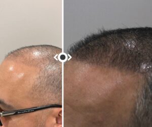 Before and After Hair Restoration