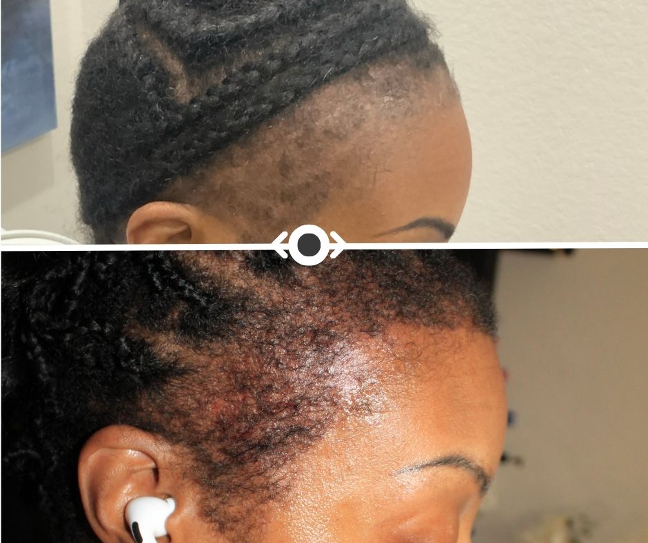 Before and After Hair Restoration