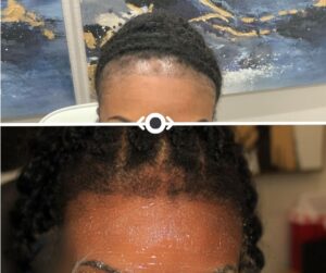 Before and After Hair Restoration