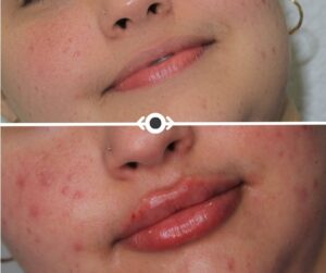Before and After Lip Filler