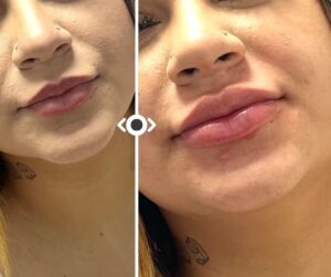Before and After Lip Filler