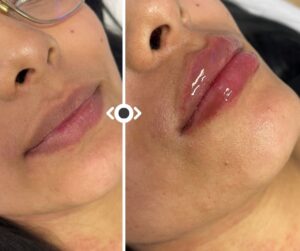 Before and After Lip Filler