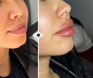 Before and After Lip Filler