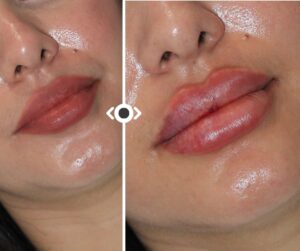 Before and After Lip Filler