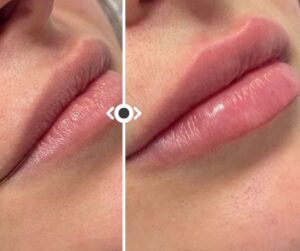 Before and After Lip Filler