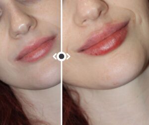 Before and After Lip Filler