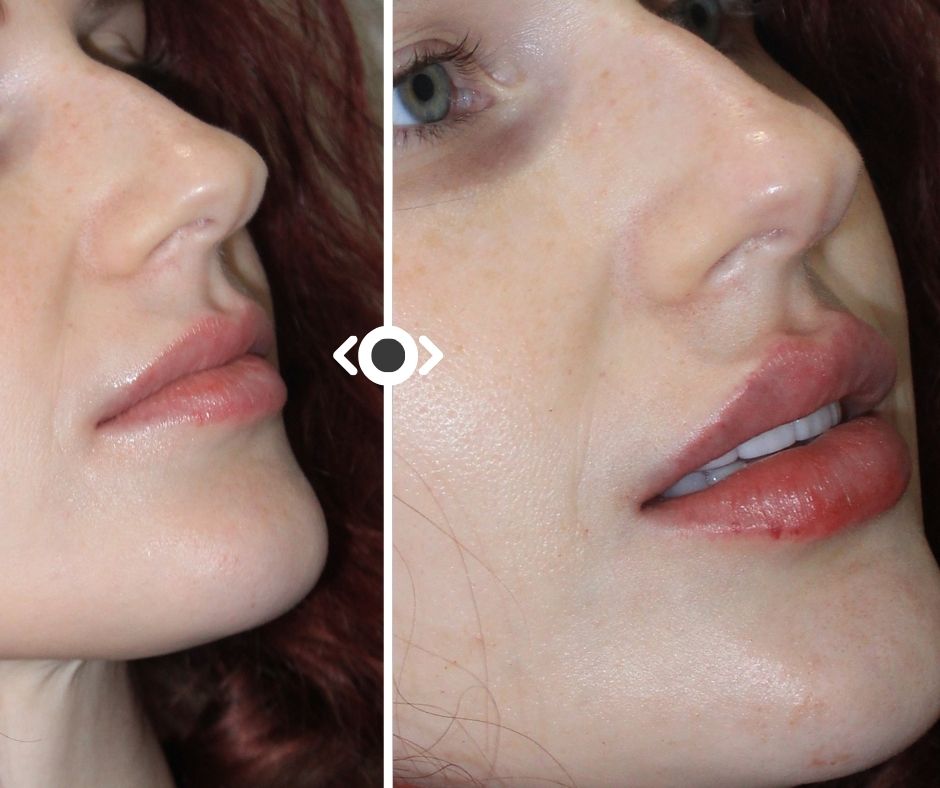Before and After Lip Filler
