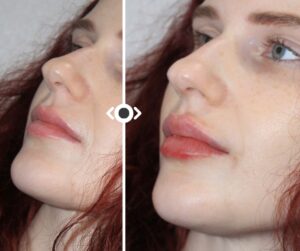 Before and After Lip Filler