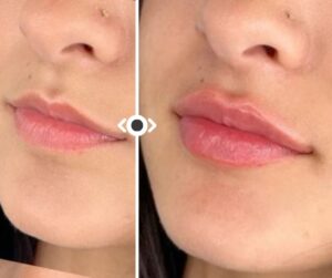 Before and After Lip Filler