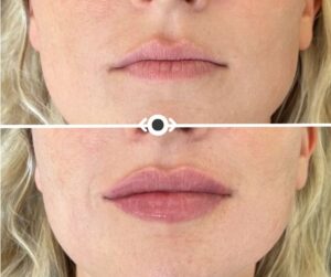 Before and After Lip Filler