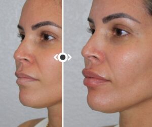 Before and After Lip Filler