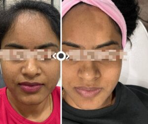 Before and After Micro-needling with PRP