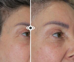 Before and After Morpheus 8
