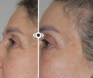 Before and After Morpheus 8