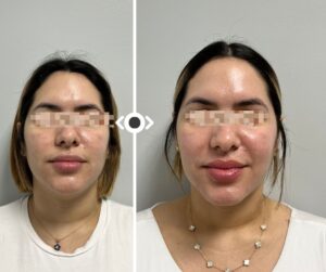 Before and After Morpheus 8