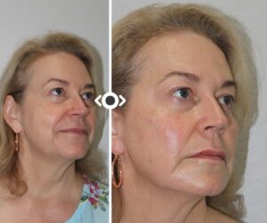 Before and After Radiesse
