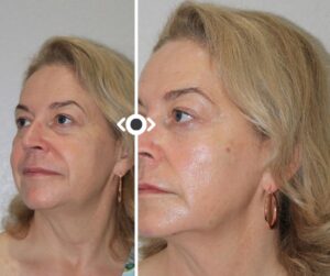 Before and After Radiesse