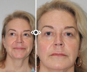 Before and After Radiesse