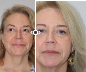 Before and After Radiesse