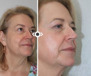 Before and After Radiesse