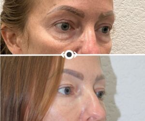 Before and After Under Eye Filler