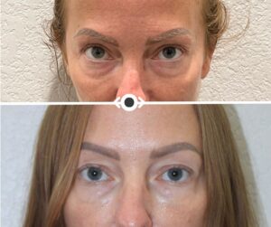 Before and After Under Eye Filler