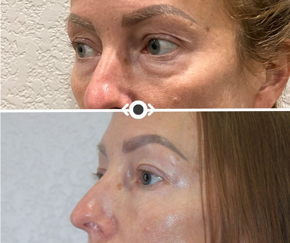 Before and After Under Eye Filler
