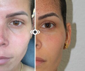 Before and After Under Eye Filler