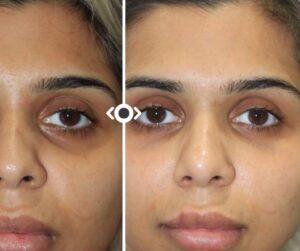 Before and After Under Eye Filler