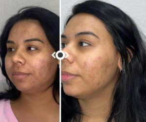 Before and After Hair Venus Versa Pro IPL
