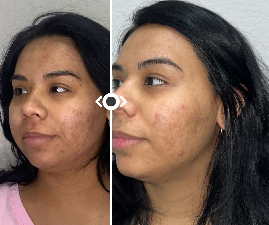 Before and After Hair Venus Versa Pro IPL