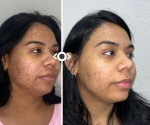 Before and After Hair Venus Versa Pro IPL