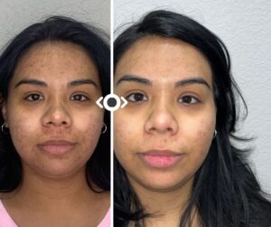 Before and After Hair Venus Versa Pro IPL