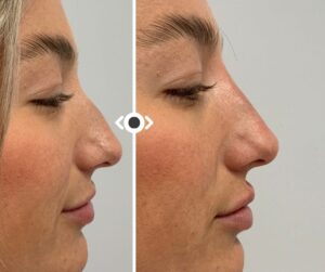 Before and After Liquid Rhinoplasty
