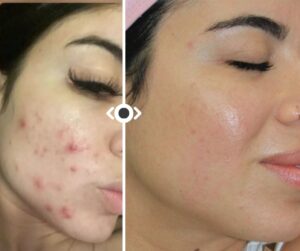 CO2 Laser e Hydrafacial