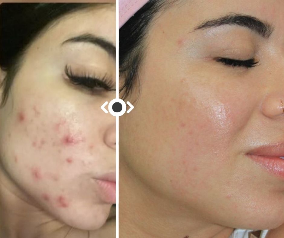 CO2 Laser e Hydrafacial