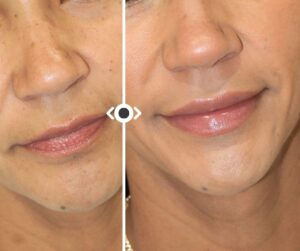 LIP Fiiler