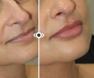 LIP Fiiler
