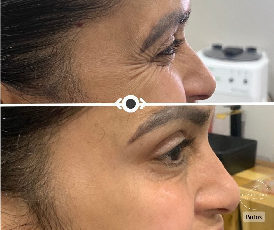 Before & After Botox