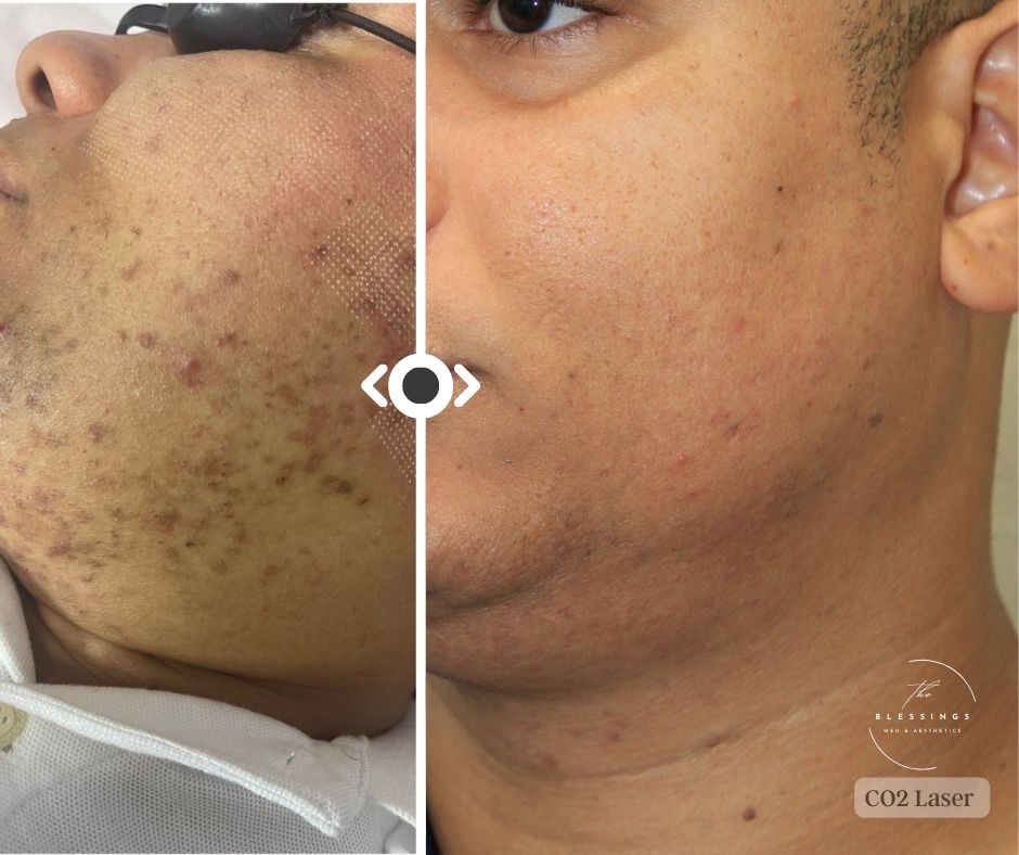 Before & After CO2 Laser