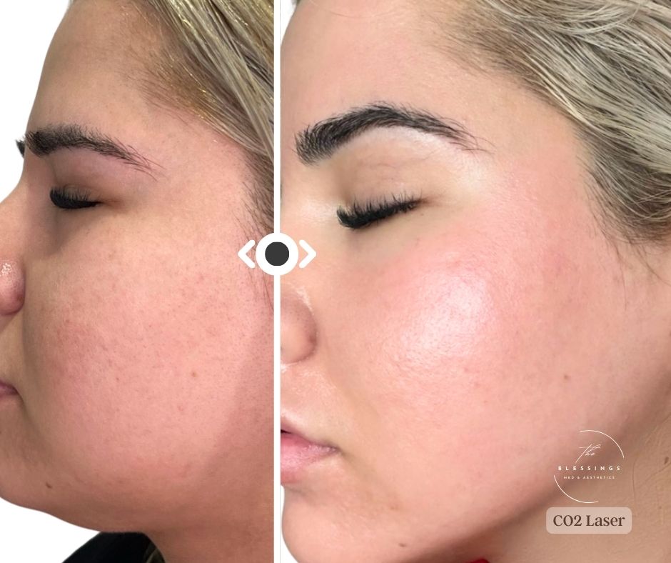 Before & After CO2 Laser