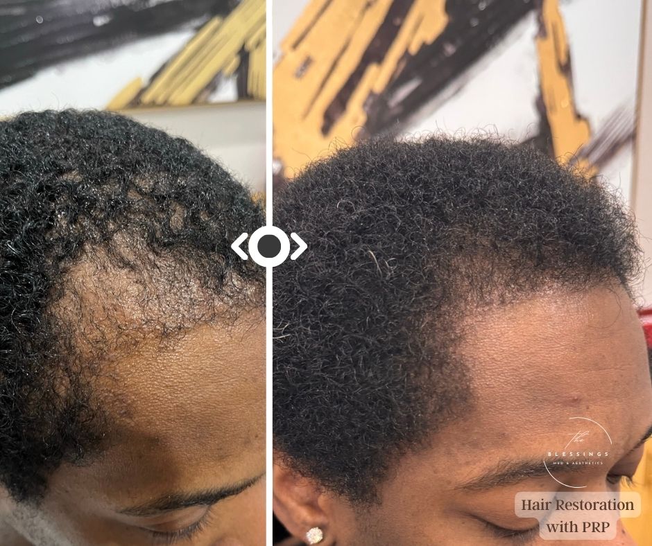 Before and After Hair Restoration
